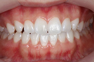 ホワイトニング | 難波の歯医者 なんばアップル歯科