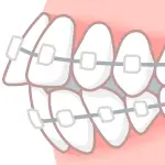 ワイヤー矯正イラスト