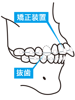 歯列矯正のイメージ