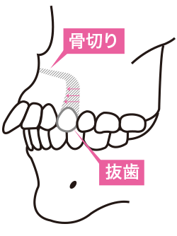 外科矯正のイメージ