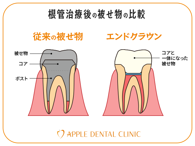 従来の被せ物とエンドクラウンの構造を比較したイラスト