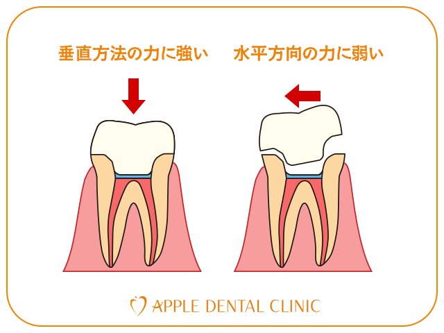 横方向の力でエンドクラウンが外れる仕組みのイラスト