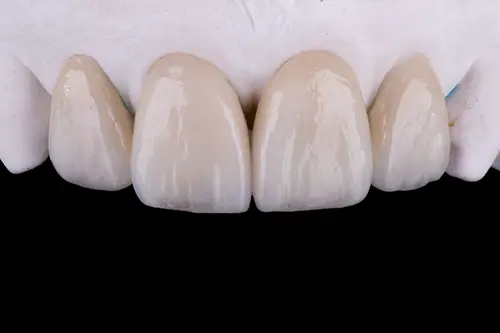 歯の審美的な治療