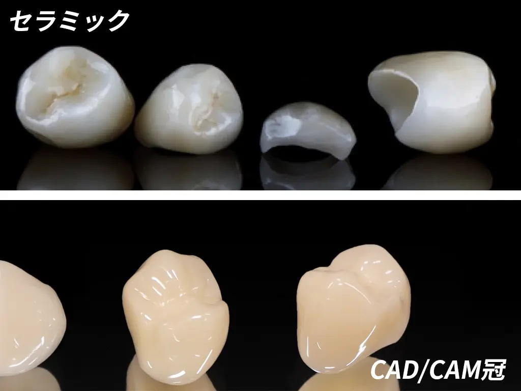 セラミックとCAD/CAM冠