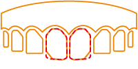 CAD/CAM冠を装着した歯