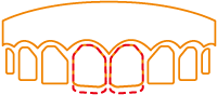 CAD/CAM冠を装着した歯