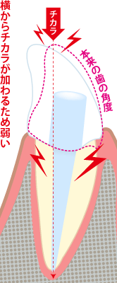 不自然な角度のセラミック