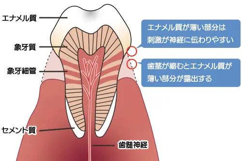 知覚過敏のメカニズム