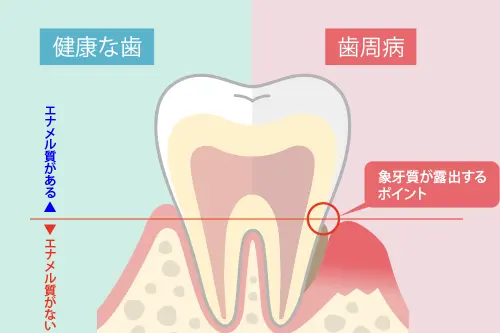 歯茎の後退による知覚過敏