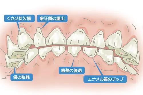 歯の咬耗や退縮の原因