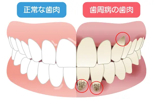 歯周病による歯茎の退縮