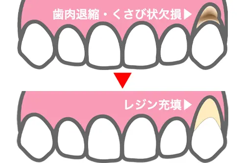 レジン充填