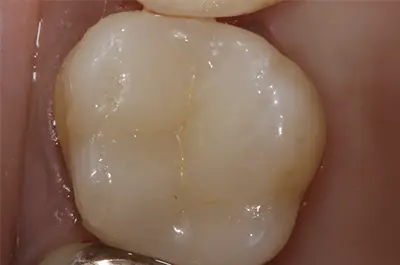 治療後のセラミック冠の臼歯