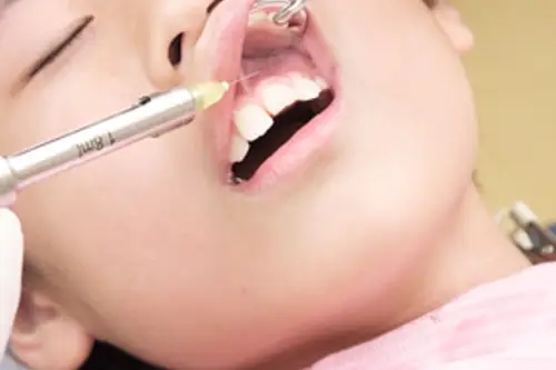 歯科麻酔の刺入