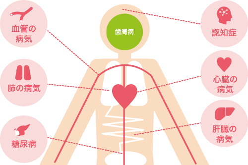 歯周病からなる病気