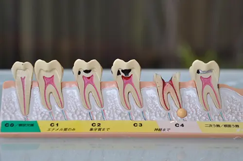 虫歯の進行説明用模型