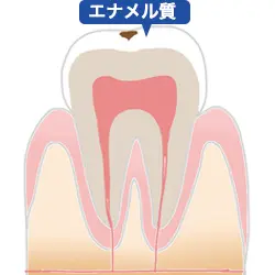 C1エナメル質虫歯