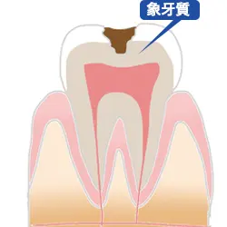 C2象牙質虫歯