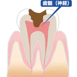 C3歯髄虫歯
