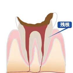 残根虫歯