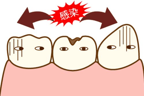 虫歯感染のイメージ
