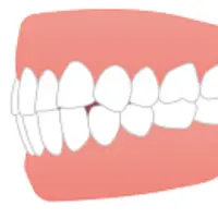 歯並びへの影響