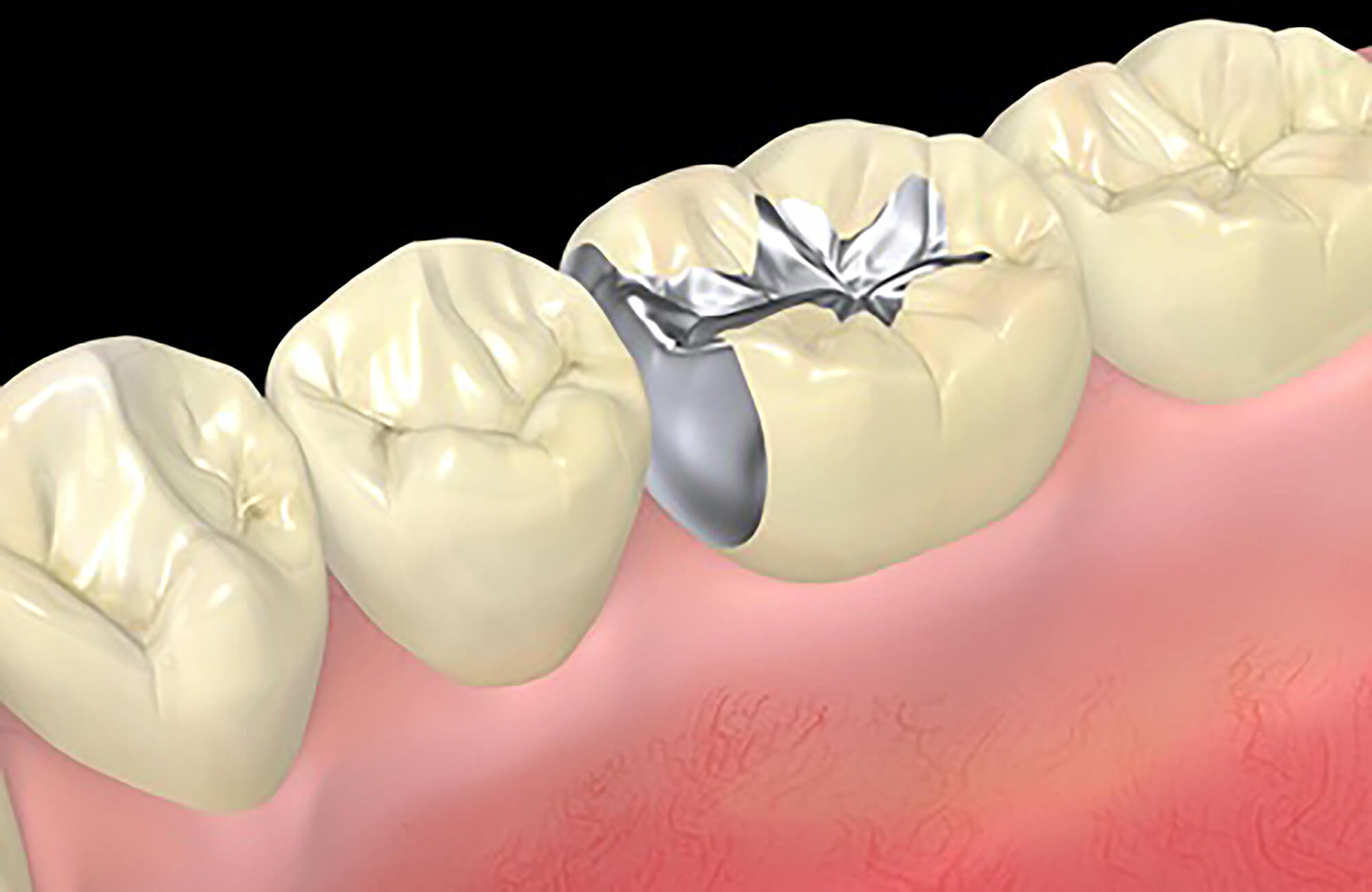 虫歯の詰め物（インレー）の種類や費用感 | 難波の歯医者 なんばアップル歯科