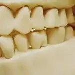 奥歯のブリッジ